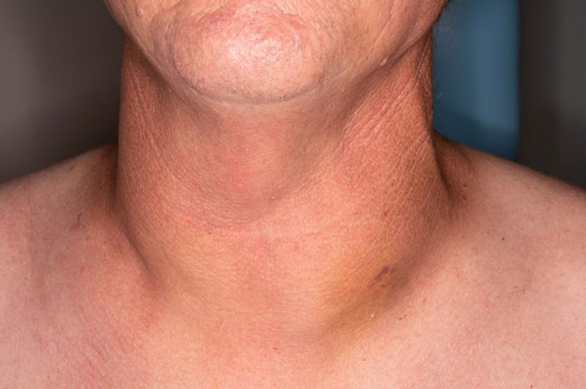 Top Symptoms of Thyroid Cancer That Are Easy to Miss